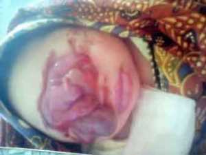 Bayi Malang Kena Tumor Butuh Pertolongan